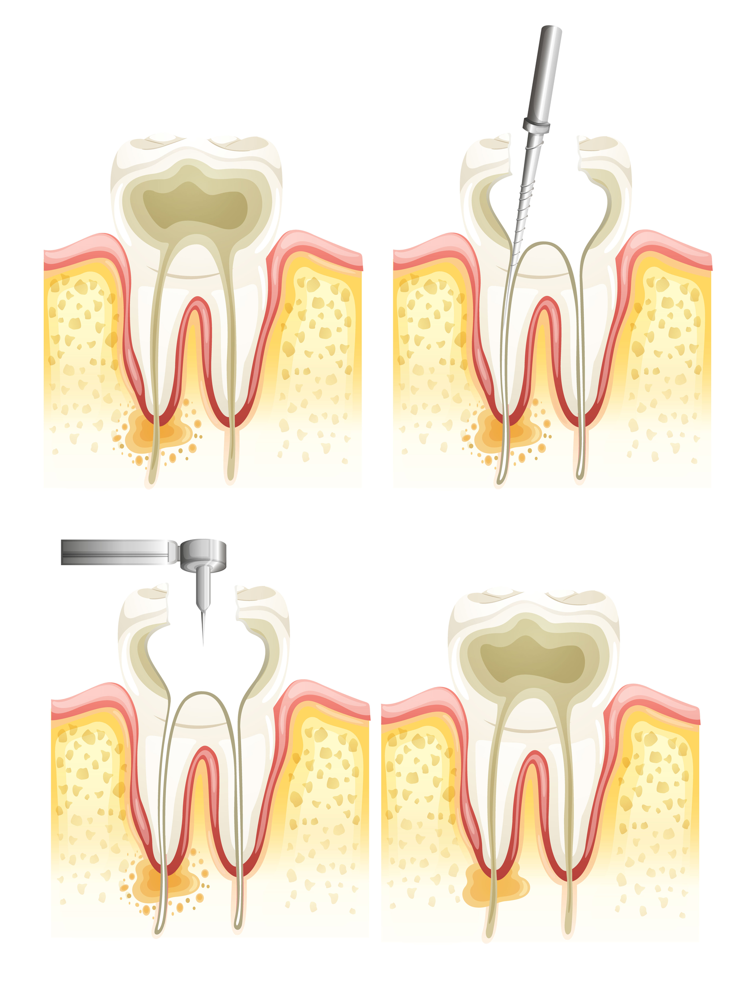 Who is the best dentist for a root canal in Doral?