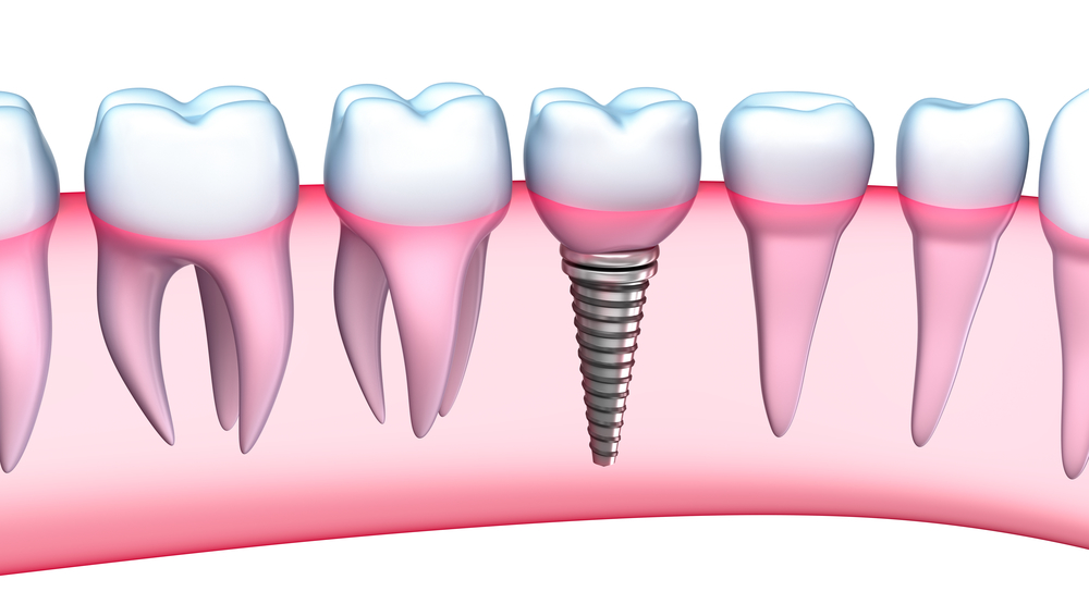 Where can I get dental implants in Doral?
