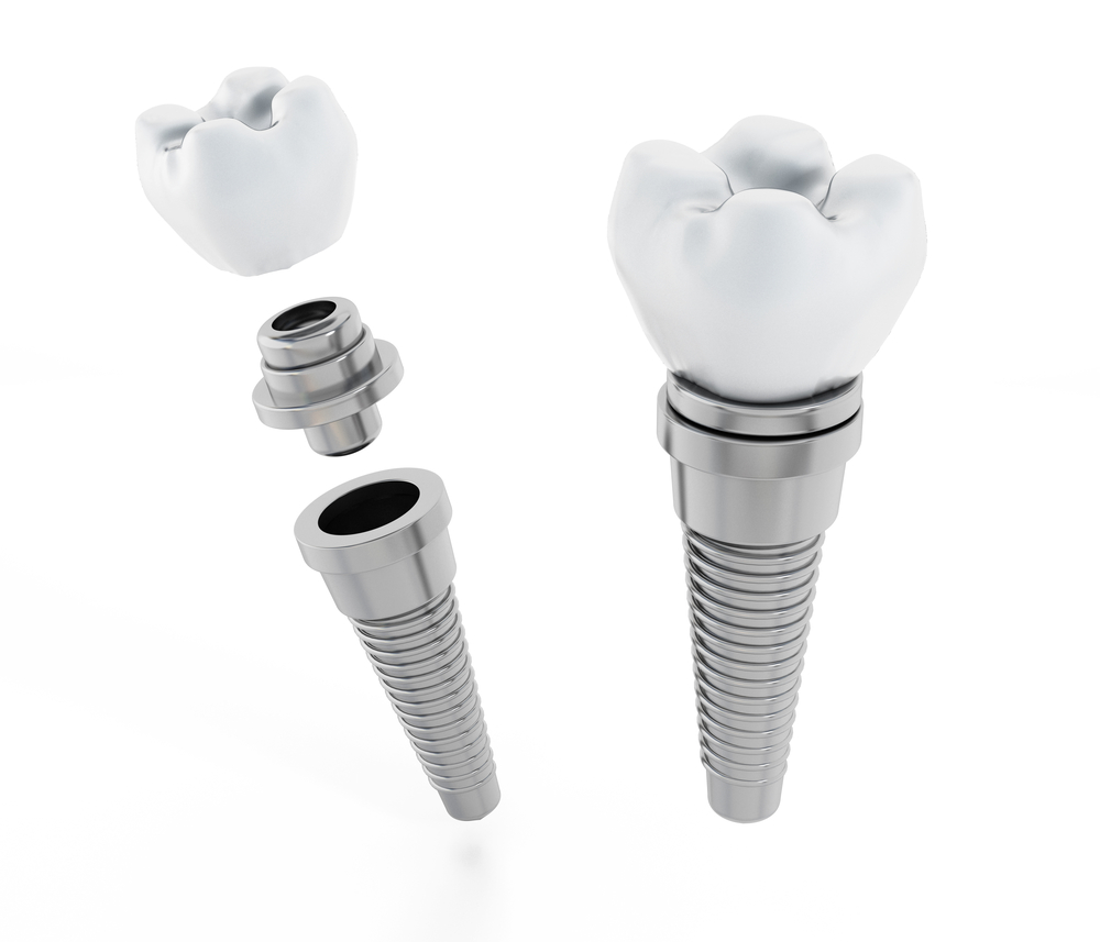 What are the benefits of getting dental implants in Weston?